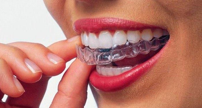 Вирівнювання зубів за приємними цінами: поради експертів